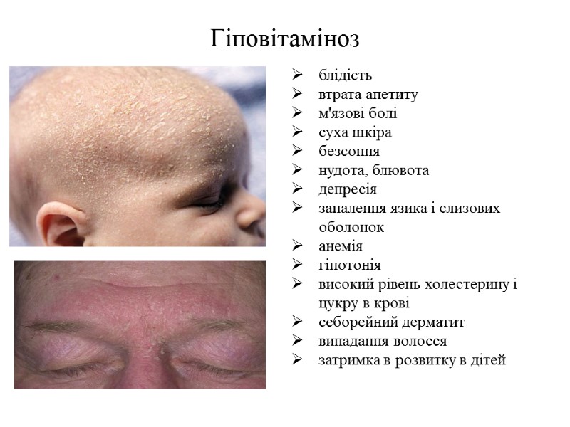 Гіповітаміноз  блідість втрата апетиту м'язові болі суха шкіра безсоння нудота, блювота депресія запалення